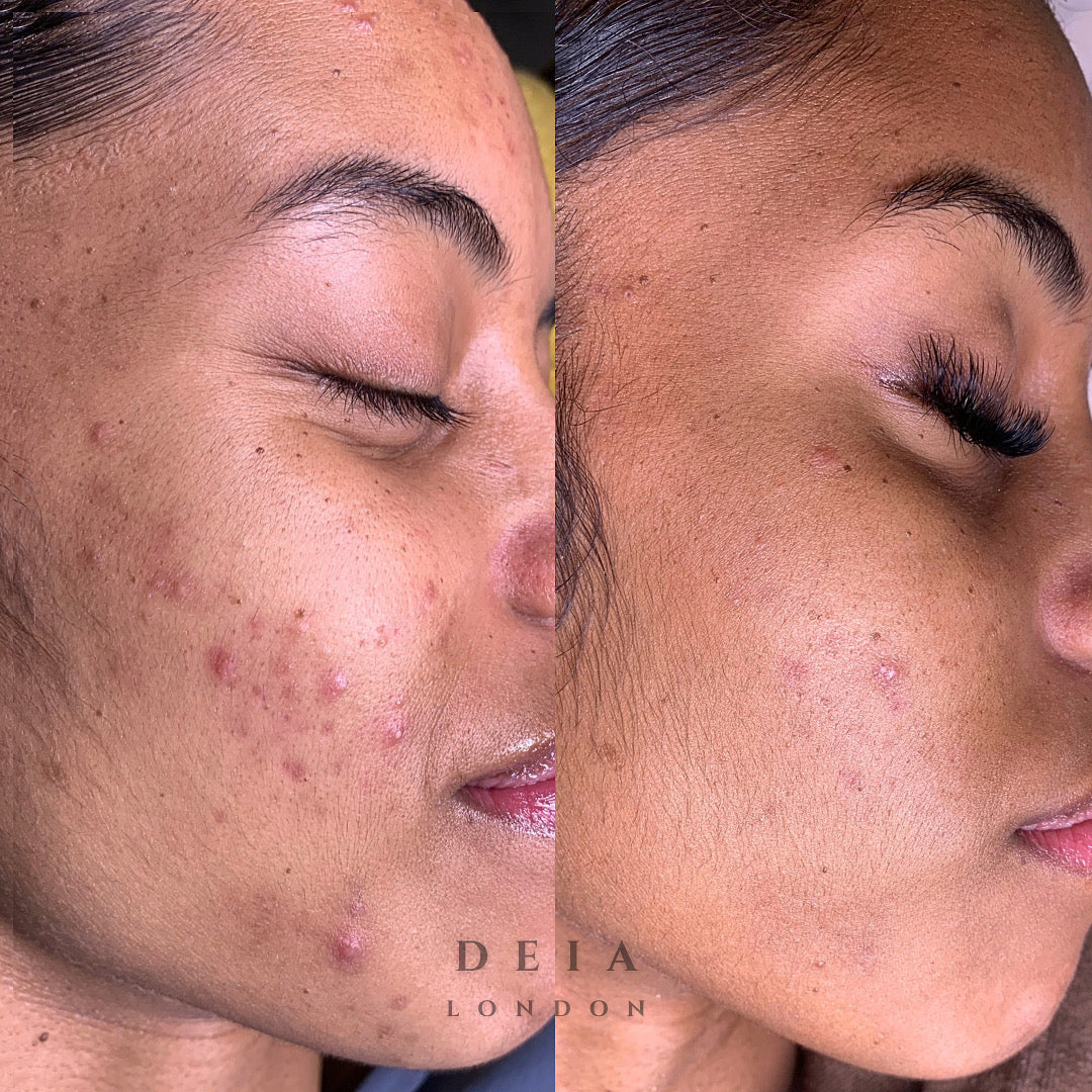FADE - THE HYPERPIGMENTATION GUIDE.