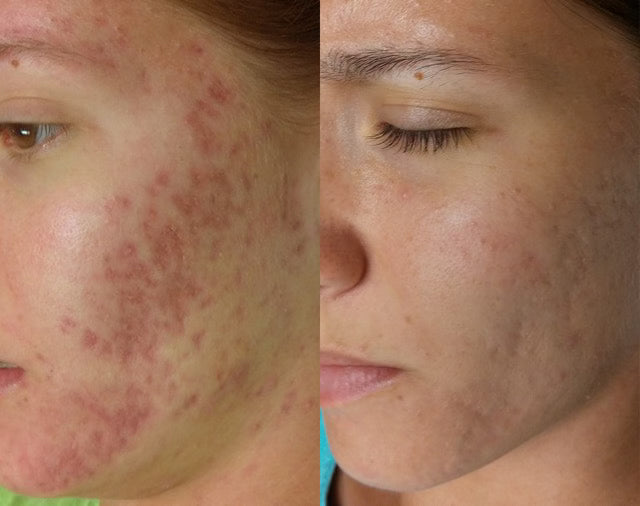NEW: SkinPen Packages