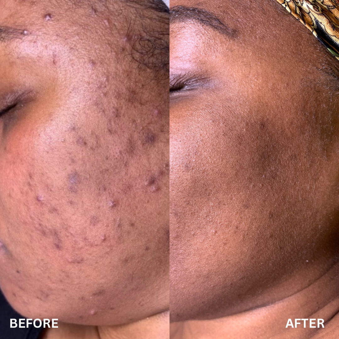 FADE - THE HYPERPIGMENTATION GUIDE.